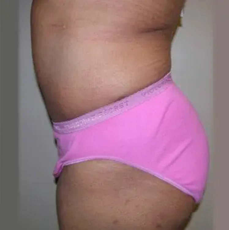 Post-Bariatric Surgery after. Side Facing
