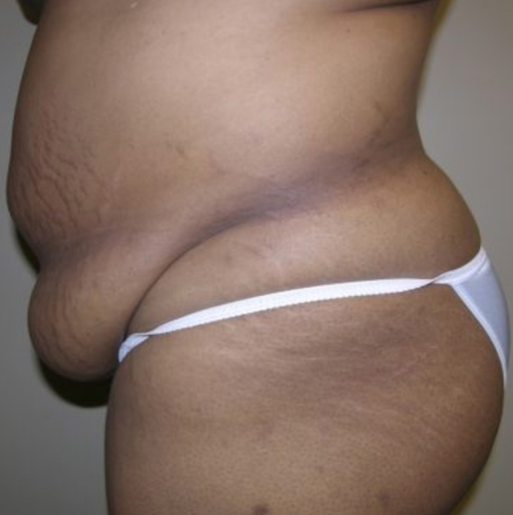 Post-Bariatric Surgery before. Side Facing