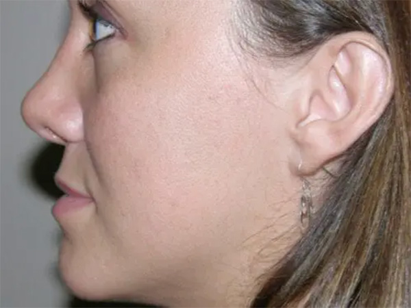 Rhinoplasty Patient 02 after