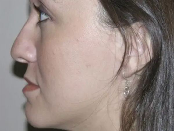 Rhinoplasty Patient 02 before