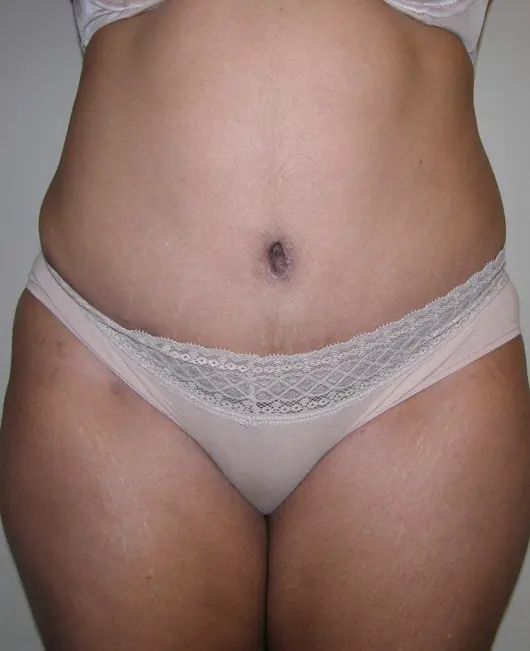 Tummy tuck after patient 2 forward facing