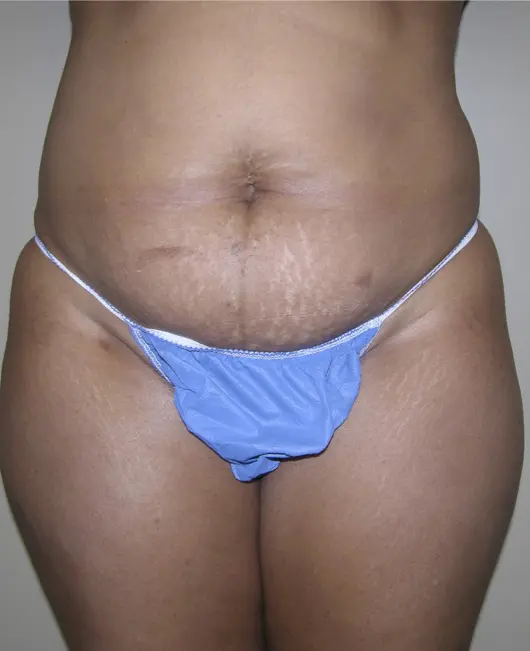 Tummy tuck before patient 2 forward facing