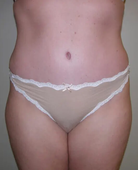 Tummy Tuck Patient 01 after