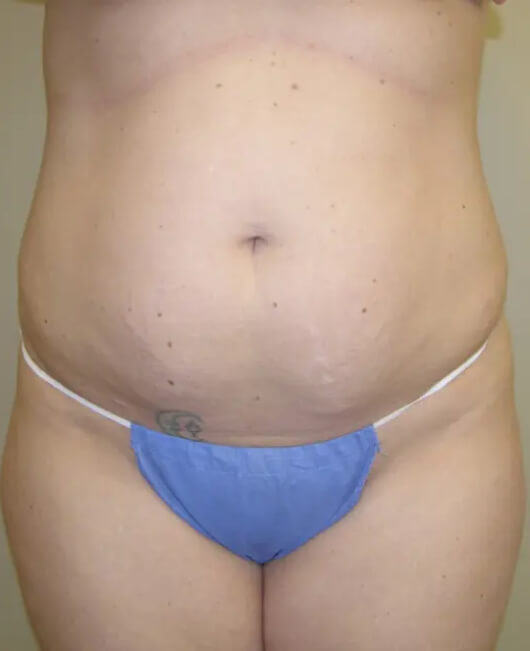 Tummy Tuck Patient 01 before