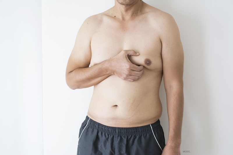 Man with gynecomastia pinches the extra fat and tissue on his chest.