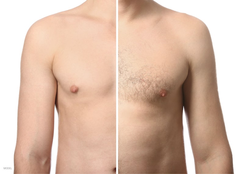 Before and after of a man treated with laser hair removal.